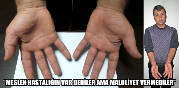 MESLEK HASTASI DİYE İŞİNE SON VERDİLER FAKAT....